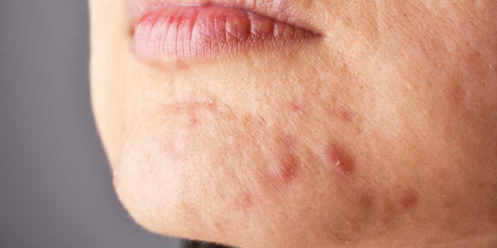 How can I prevent breakouts?