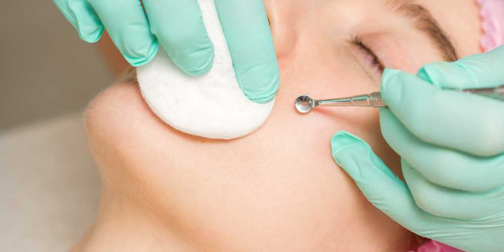 How can I get rid of blackheads?